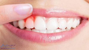دندانپزشک برای افزایش طول تاج دندان در شیراز + آدرس و شماره تماس دندانپزشک زیبایی