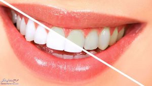 همه چیز درباره بلیچینگ و سفید کردن دندان ها بعد از ارتودنسی
