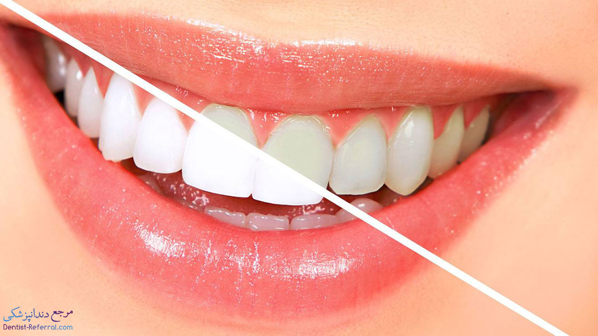 بلیچینگ و سفید کردن دندان ها بعد از ارتودنسی