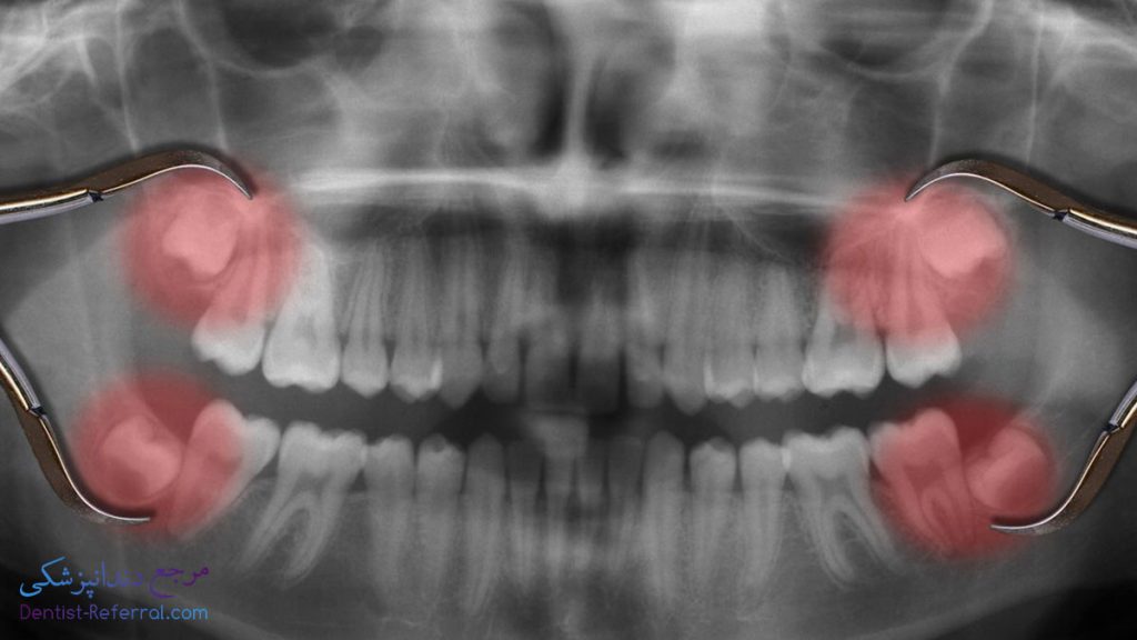 جراح دندان عقل در شیراز