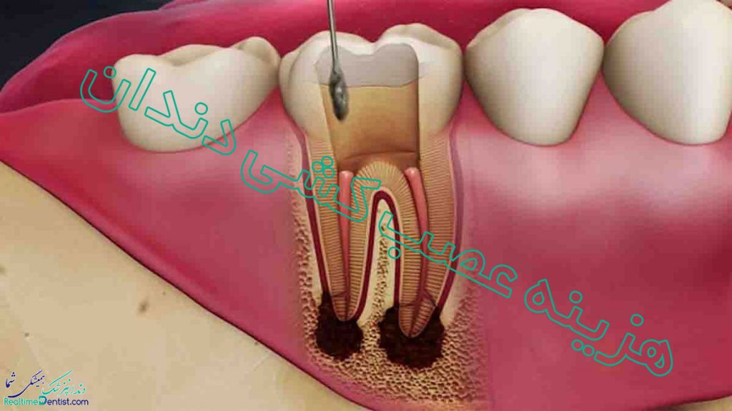 هزینه عصب کشی دندان