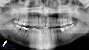 هزینه جراحی دندان نهفته چقدر است؟