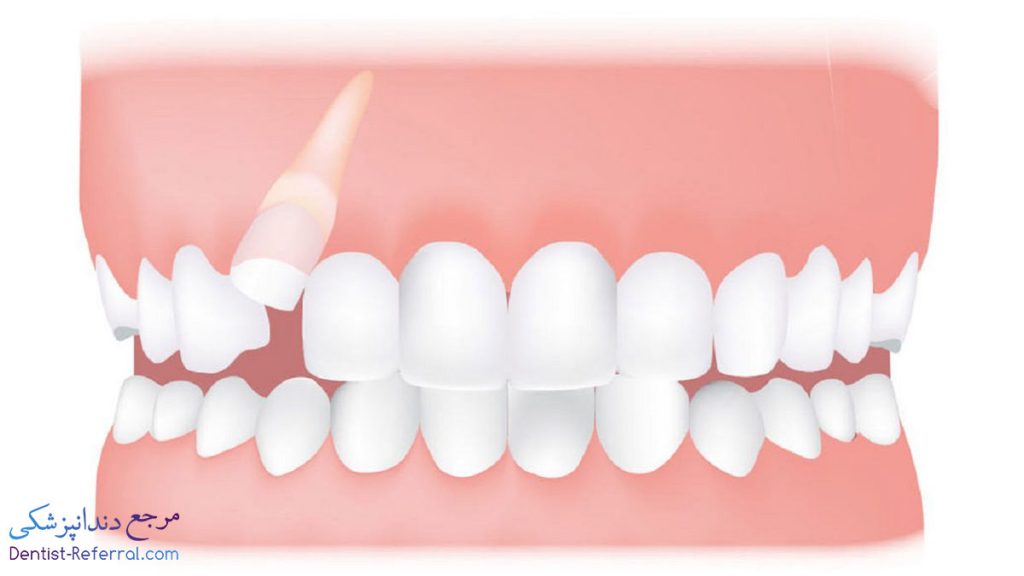 هزینه جراحی افزایش طول تاج دندان
