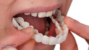 پروتز دندان چیست؟ و انواع پروتز دندان چه کاربردی دارد؟
