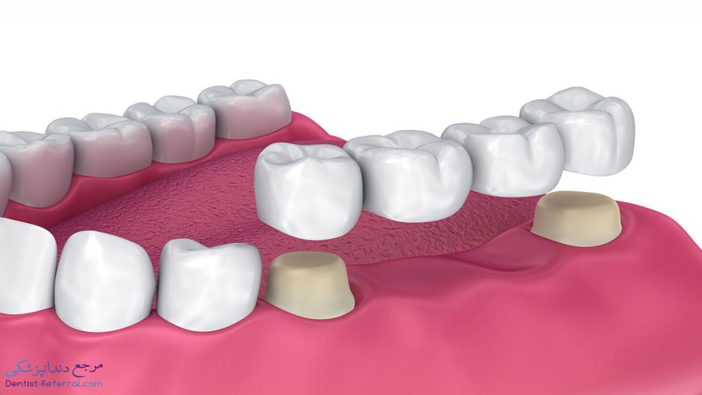 بریج دندان یا پل دندانی چیست؟