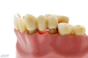بریج دندان یا پل دندانی چیست؟