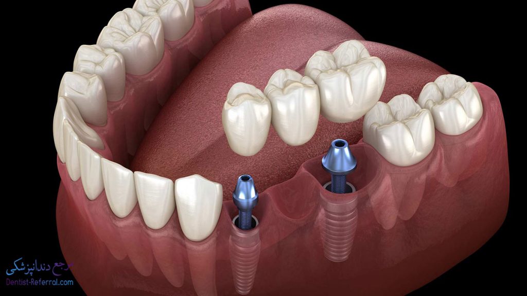چگونه از ایمپلنت دندان خود مراقبت کنیم؟