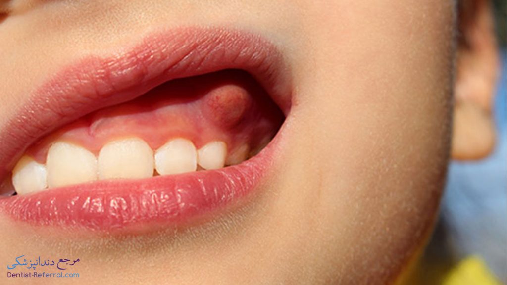 آبسه دندان، علائم، علت و راه های درمان آن چیست؟