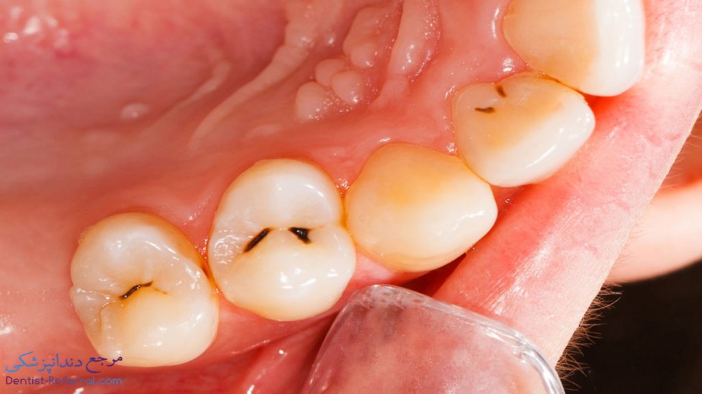 روش های درمان پوسیدگی دندان در خانه