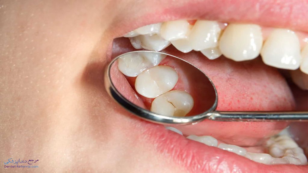 طول عمر کامپوزیت دندان چقدر است؟
