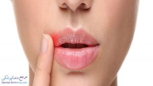 راه های درمان آفت دهان با روش های خانگی