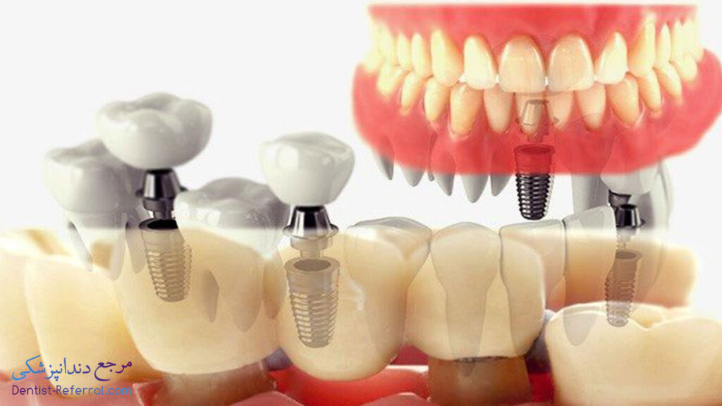 انتقال دندان مصنوعی به ایمپلنت