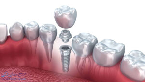 معرفی انواع ایمپلنت دندان
