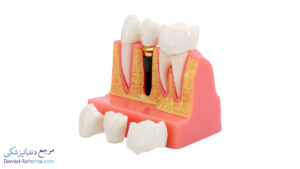 بهترین نوع ایمپلنت دندان چیست؟