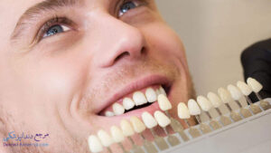برداشتن لمینت دندان چه زمانی لازم می باشد؟
