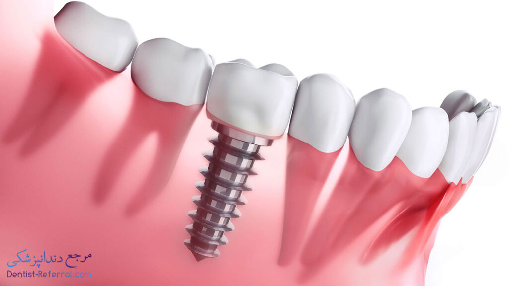 بهترین روش های جایگزین برای دندان از دست رفته
