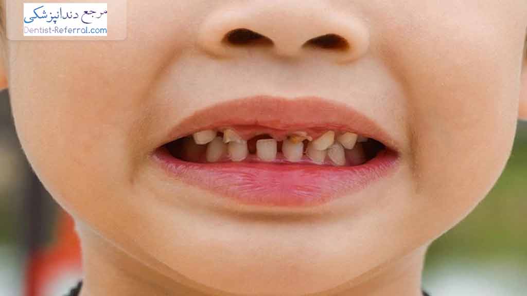 پیشگیری از پوسیدگی دندان درکودکان