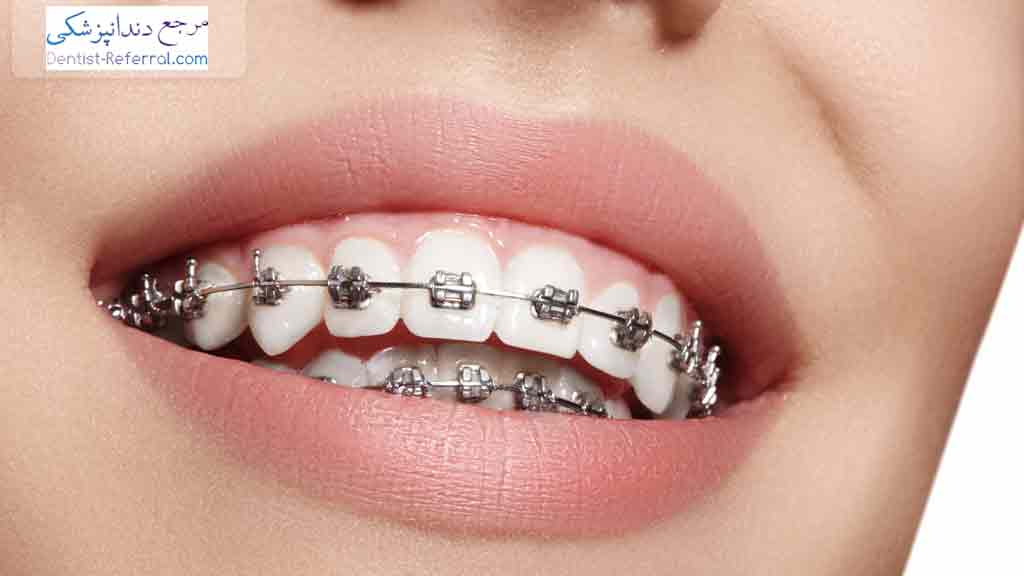زیباسازی دندان ها
