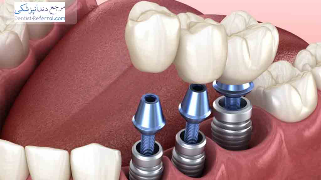 هزینه ایمپلنت دندان چقدر است؟