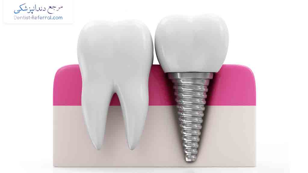 هزینه ایمپلنت دندان چقدر است؟