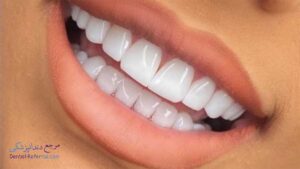بهترین دندانپزشک کامپوزیت دندان در معالی آباد شیراز