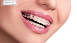 هزینه ارتودنسی دندان چقدر است؟
