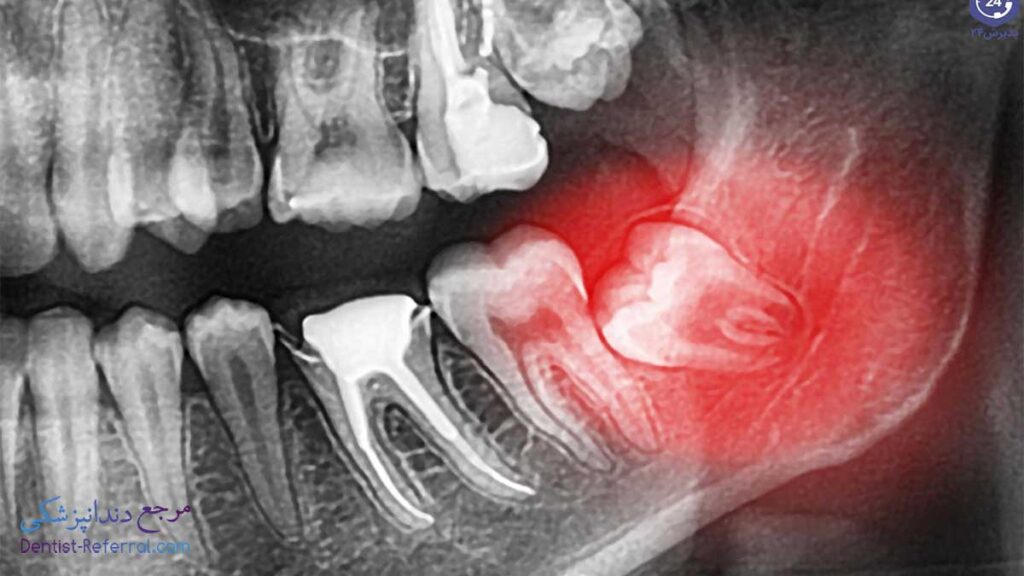 جراحی دندان عقل اقساطی در شیراز
