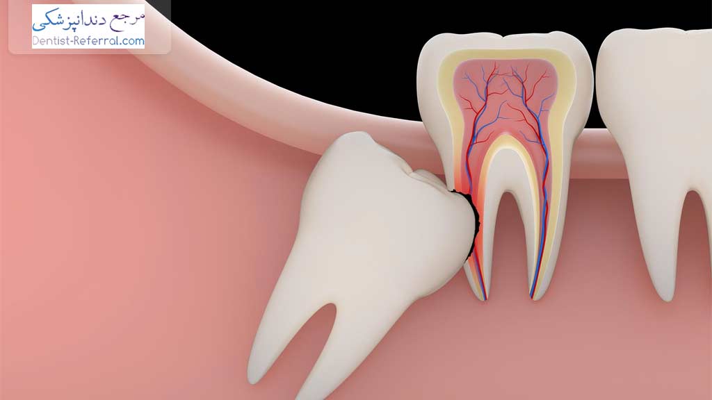 تفاوت جراحی دندان نهفته با اکسپوز کردن دندان نهفته چیست؟