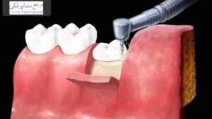 جراحی دندان نهفته چه فرقی با اکسپوز کردن دندان نهفته دارد؟